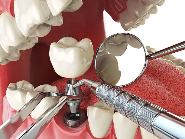 Best Lost Filling or Crown Replacement in Canyonville, OR