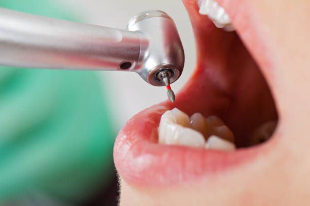 Best Emergency Wisdom Tooth Extraction in Canyonville, OR